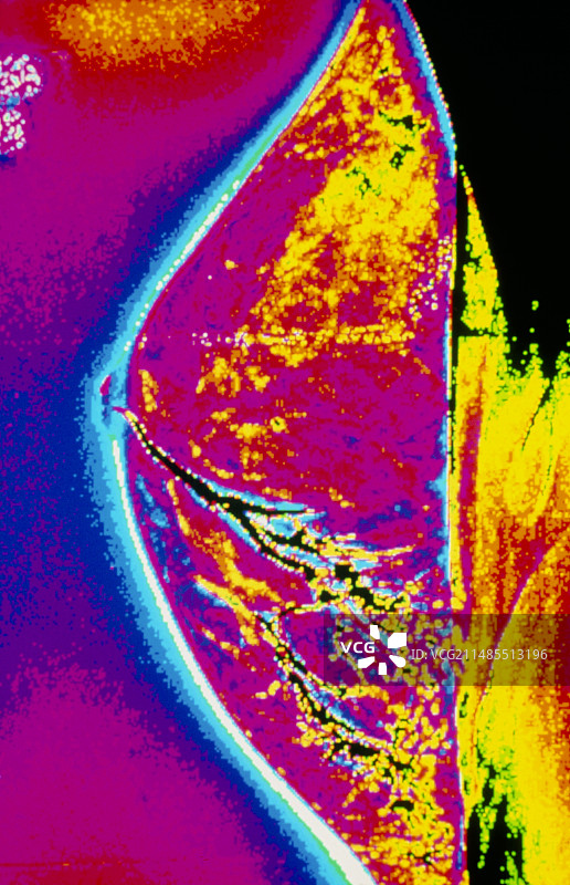人乳乳腺的乳腺导管X光照片图片素材