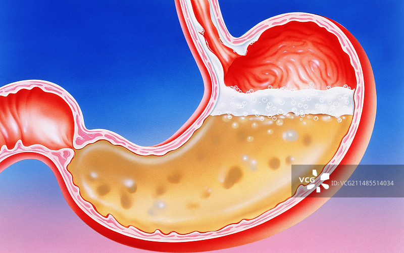 胃部烧心（酸消化不良）艺术作品图片素材