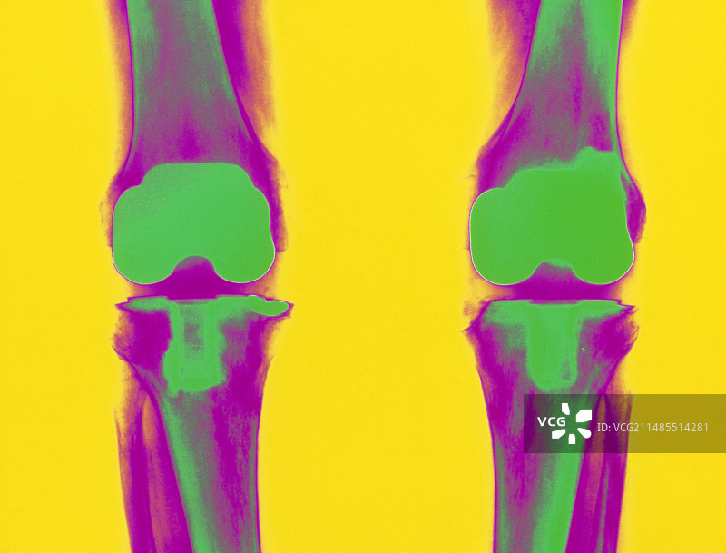 假肢膝关节的彩色X光片图片素材