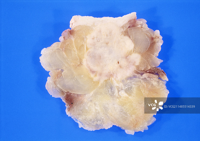 切除的乳腺癌大标本图片素材