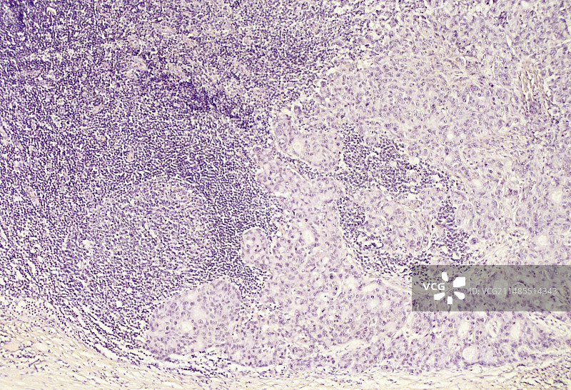 转移性乳腺癌淋巴结的光学显微镜图图片素材