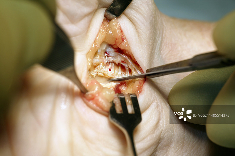 腕管综合征手术图片素材