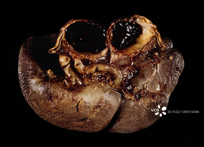 脾动脉瘤，肉眼观察图片素材