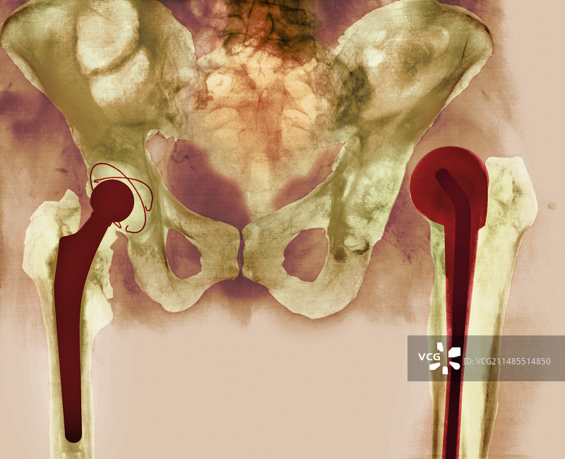 髋关节置换失败X光片图片素材