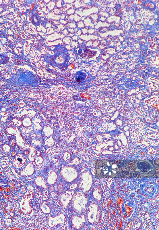肾脏肾小球萎缩的光学显微镜照片图片素材