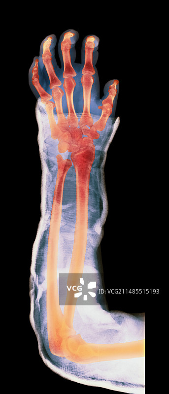 骨折手臂的石膏X光片图片素材