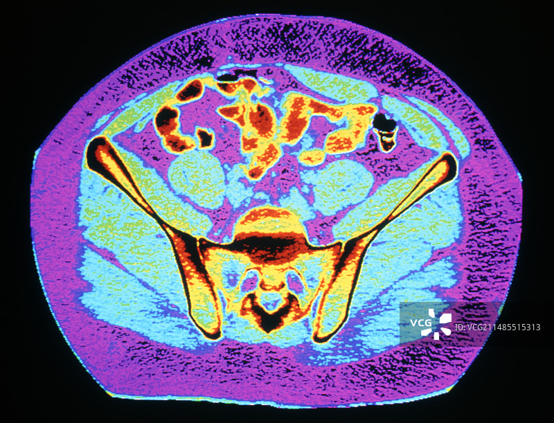 正常成年人骨盆的彩色CT扫描图片素材