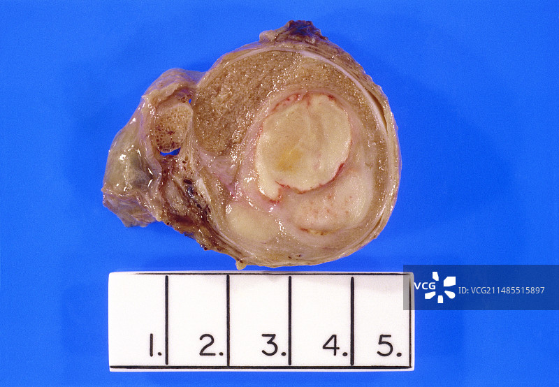 人类睾丸组织切片，显示精原细胞瘤图片素材