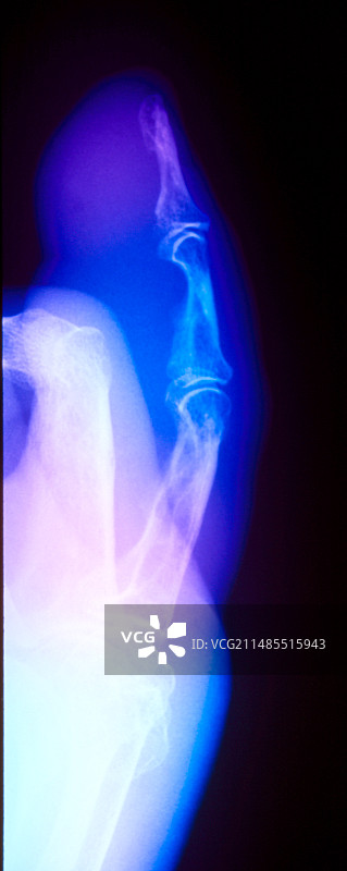 手指的彩色X光片：骨结核图片素材