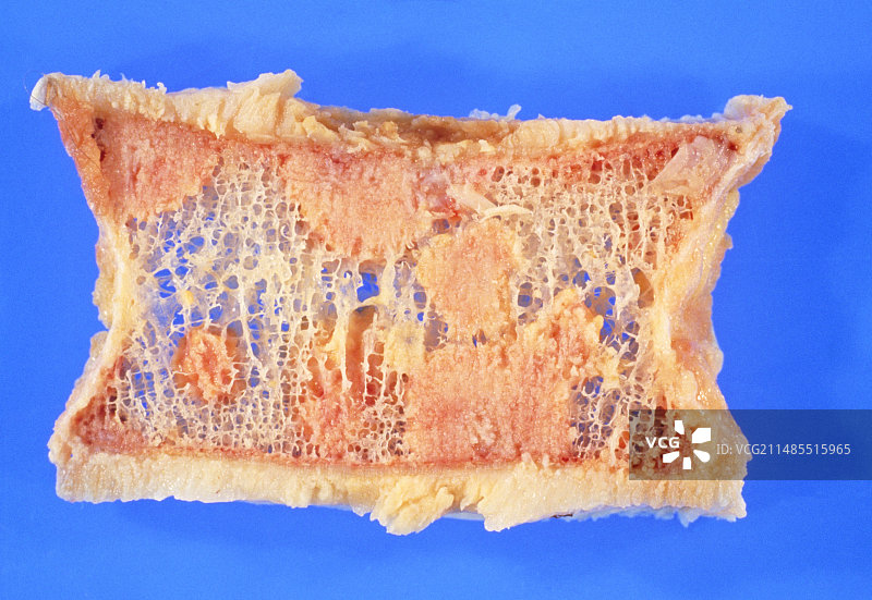 患有骨质疏松症和转移性癌症的脊椎图片素材