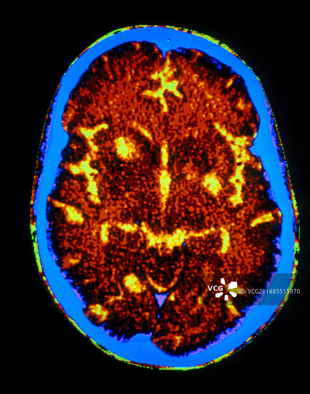 艾滋病患者弓形虫病脑部CT扫描图片素材