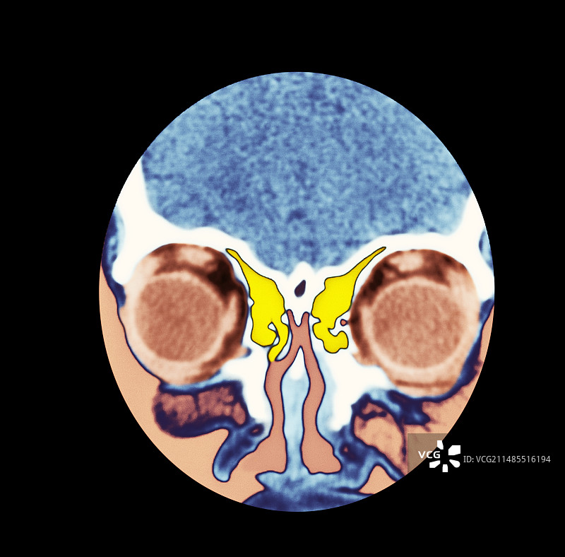 鼻子和鼻窦CT扫描图片素材