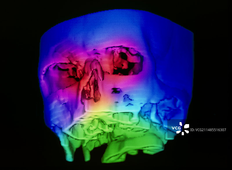 断裂鼻骨的伪彩3D CT扫描图片素材