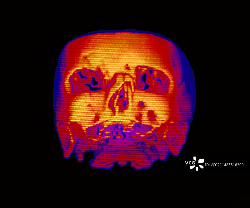 断裂鼻骨的伪彩3D CT扫描图片素材