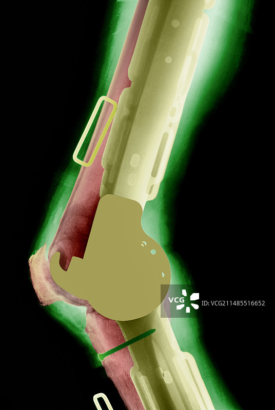 膝关节假体X光片图片素材