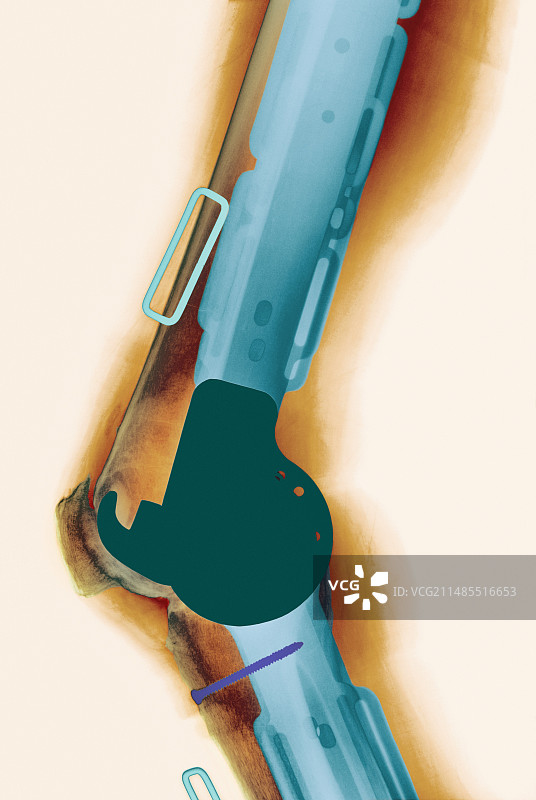 膝关节假体X光片图片素材