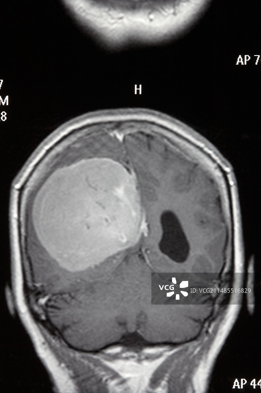 脑膜瘤图片素材