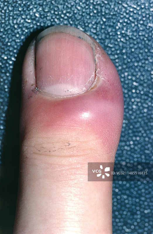手指急性甲沟炎图片素材