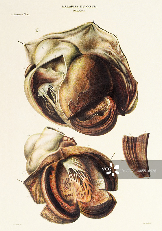 主动脉动脉瘤图片素材