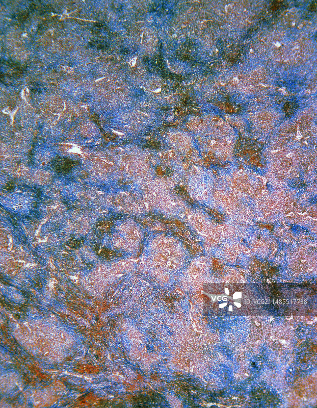 慢性白血病人脾脏切片的光学显微镜照片图片素材