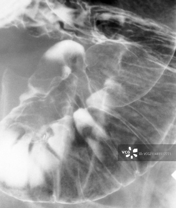 十二指肠溃疡的钡餐X光片图片素材