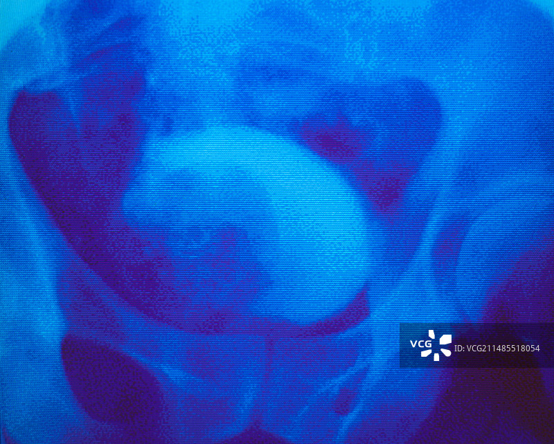 伪彩色IVU显示前列腺肥大图片素材