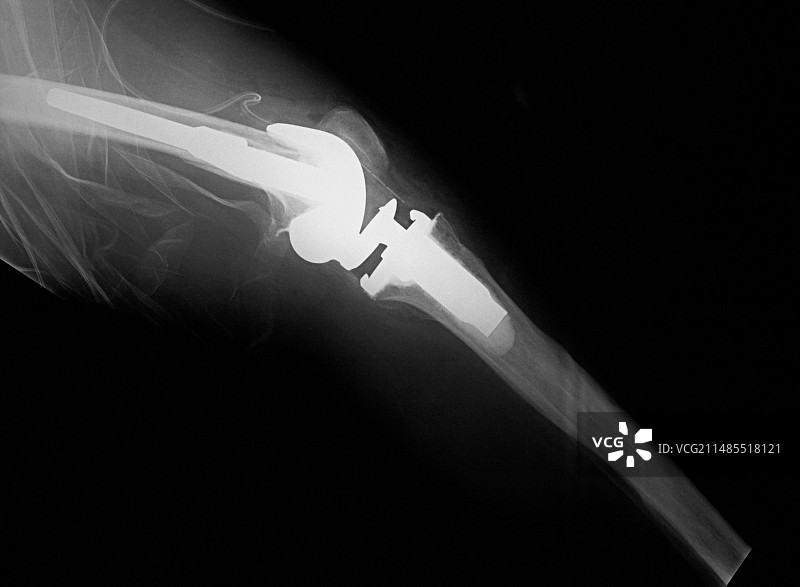 膝关节置换X光片图片素材