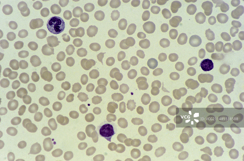 血涂片急性淋巴细胞白血病图片素材