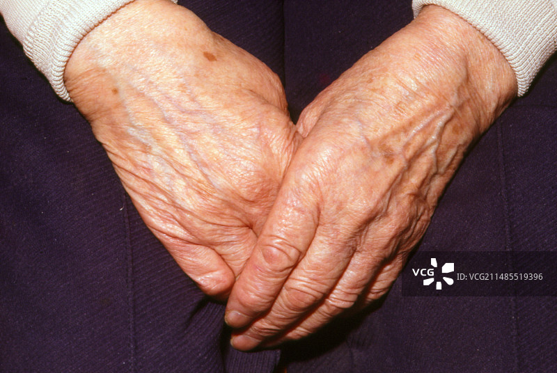 老年妇女手上的肝斑图片素材