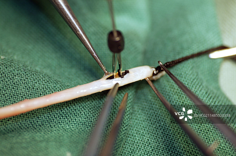 心脏搭桥手术图片素材