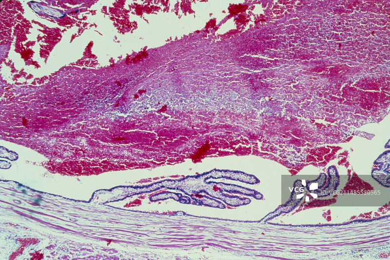 异位妊娠图片素材