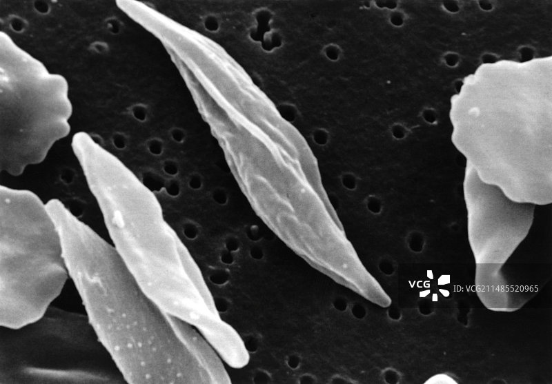 镰状细胞贫血症中畸形红细胞的扫描电镜图图片素材