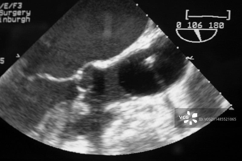 心脏瓣膜手术超声扫描图片素材