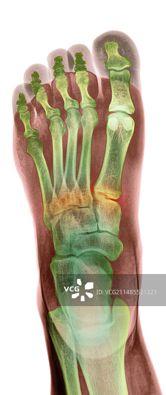足部骨折X光片图片素材