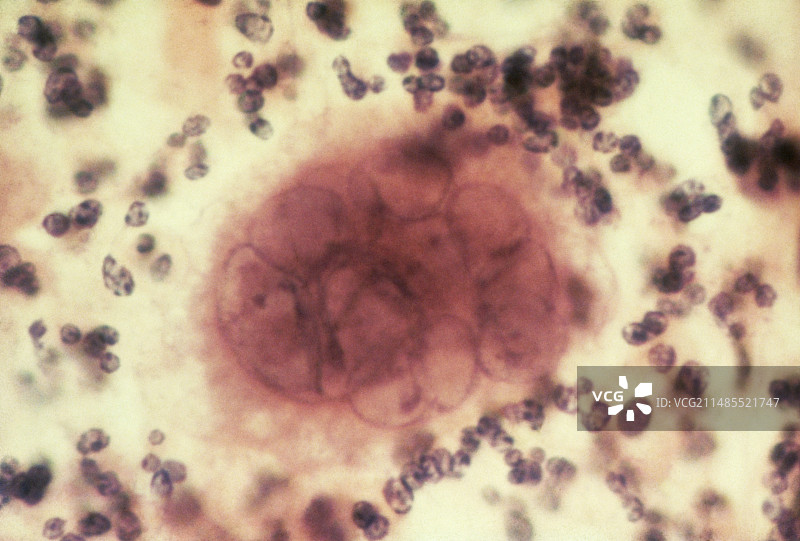 感染单纯疱疹病毒的宫颈涂片光镜图图片素材