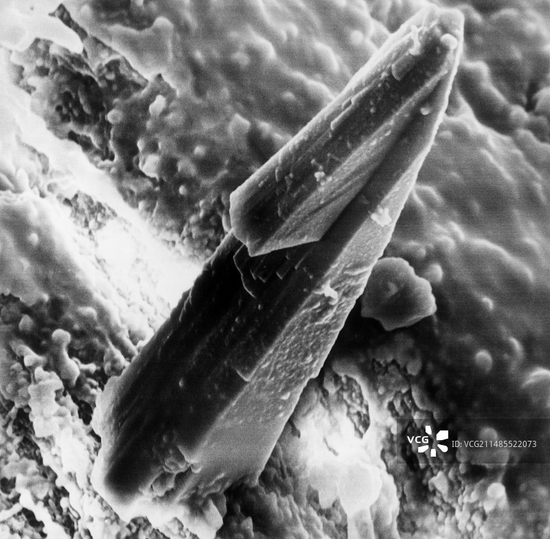 膝关节中的磷酸钙晶体图片素材