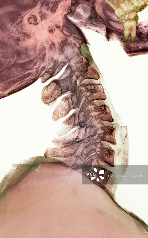 颈椎弯曲X光片图片素材