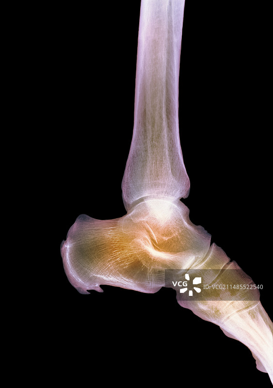 健康的脚踝X光片图片素材