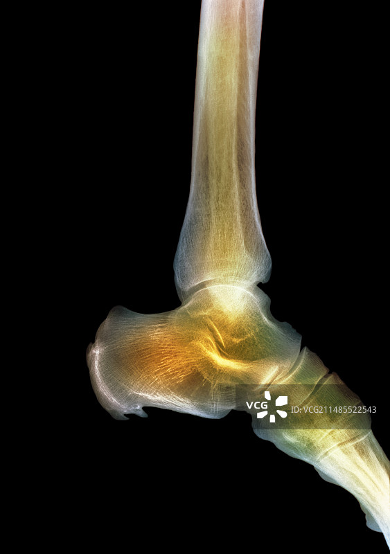 健康的脚踝X光片图片素材