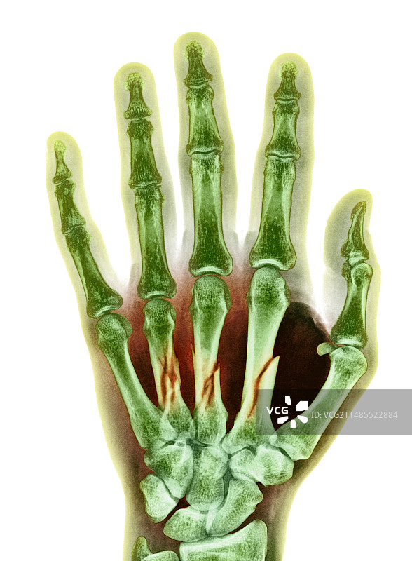 手掌骨骨折X光片图片素材