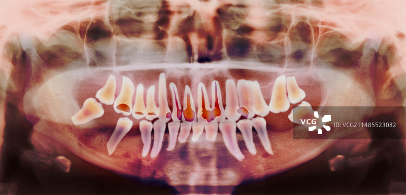 根管治疗牙科X光片图片素材