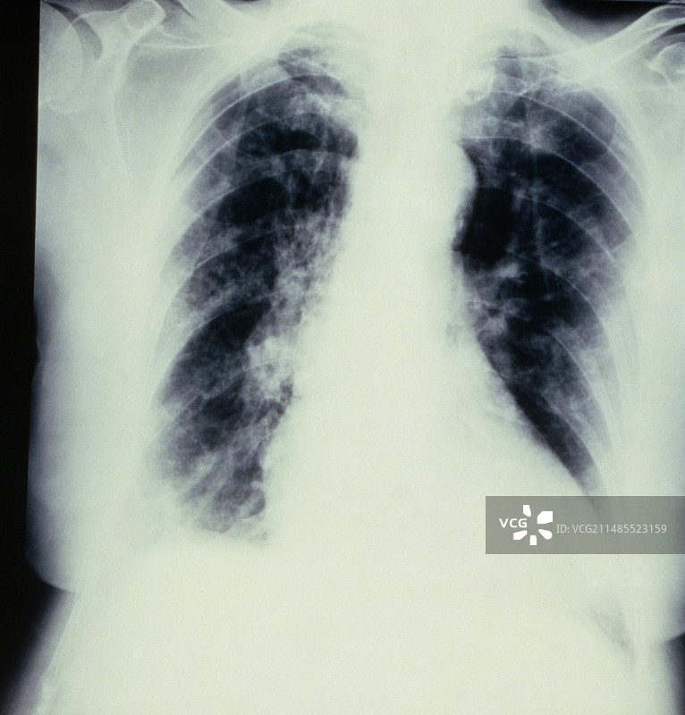 胸部X光片显示支气管肺炎图片素材
