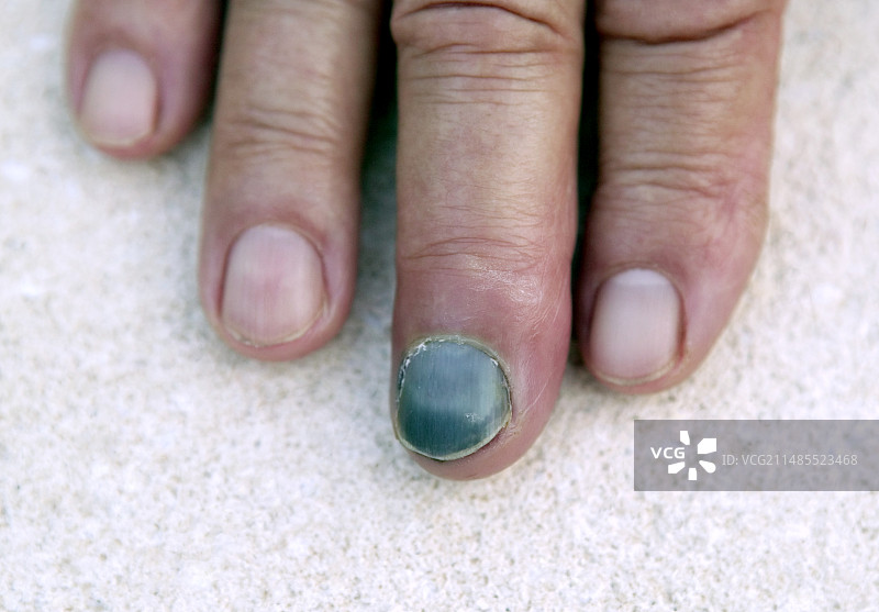 瘀伤的指甲图片素材