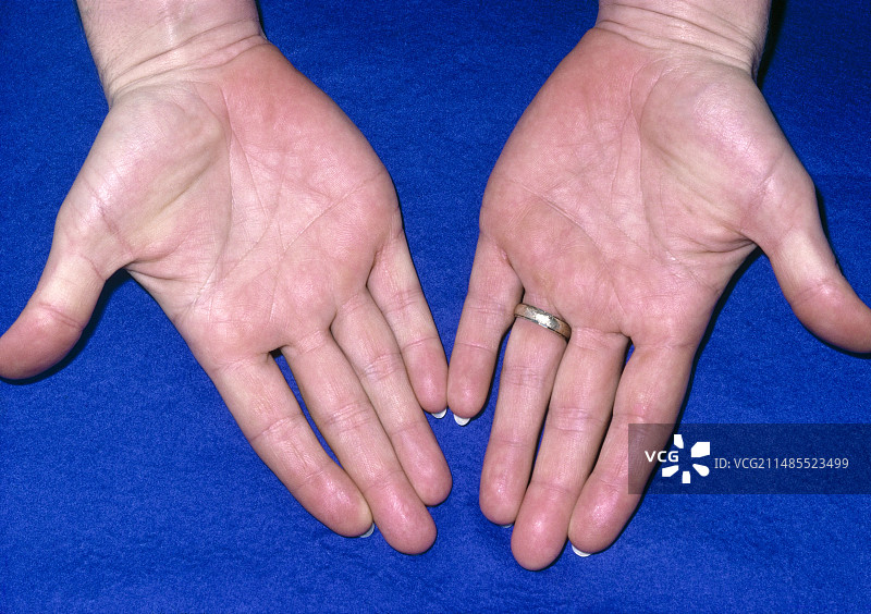 患有黄血病的人的手图片素材