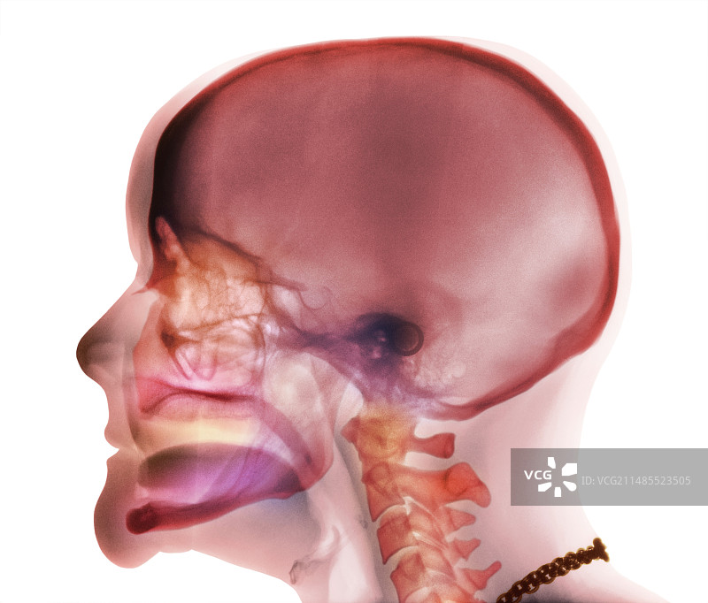 牙齿完全脱落X光片图片素材