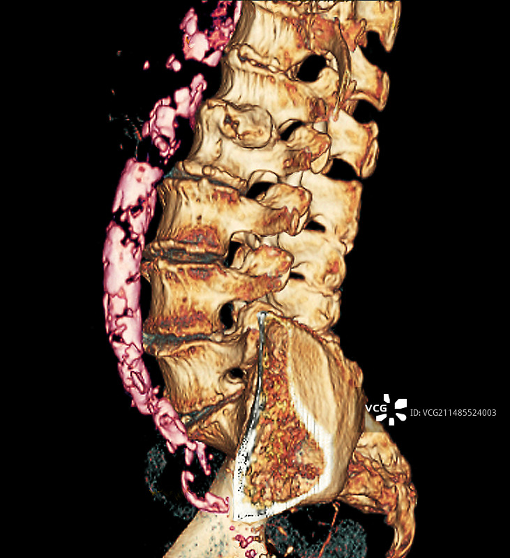 动脉粥样硬化斑块CT扫描图片素材