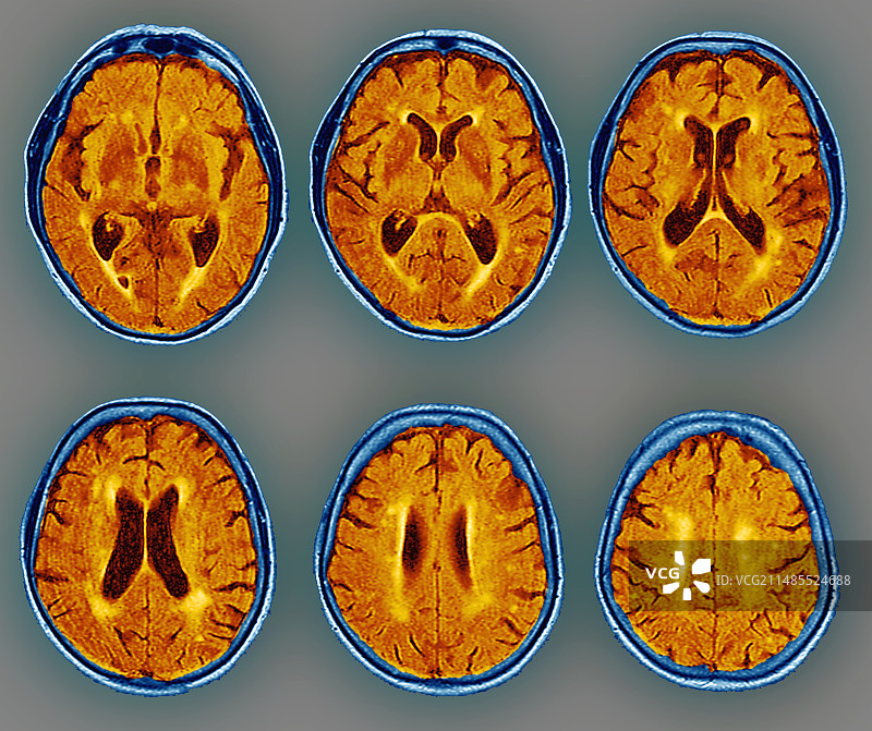 痴呆症，核磁共振扫描图片素材