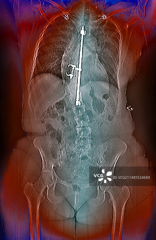 脊柱侧弯的治疗X光片图片素材