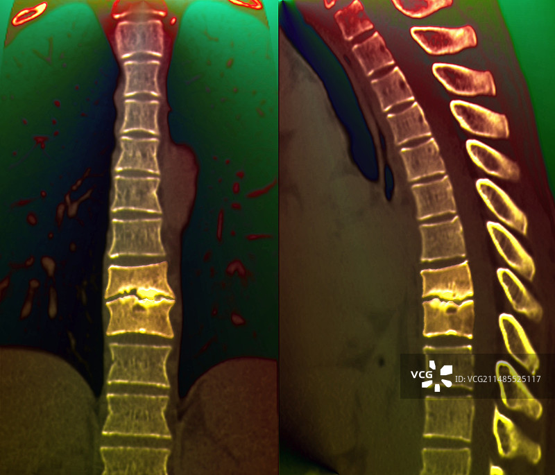 感染的脊柱CT扫描图片素材