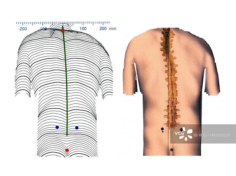 背部脊柱侧弯轮廓图图片素材